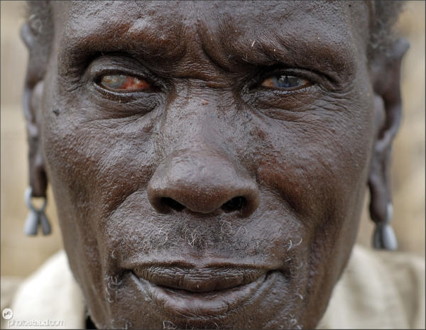 Blind man of El Molo - drinking water from Lake Turkana brings many health problems to El Molo population, Northern Kenya